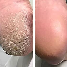 Дисковый педикюр