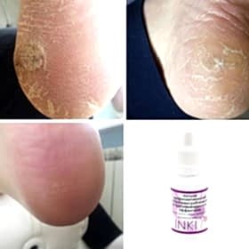 Карбамидный педикюр INKI PROFI