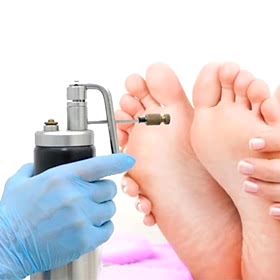 Удаление натоптышей